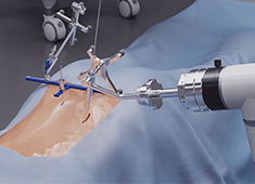 骨科手術(shù)機器人收費標準:導(dǎo)航功能2000元封頂