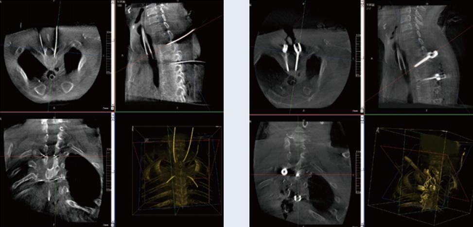 三維C臂與骨科導航機器人配合應用(助力骨科手術更準確) 三維C臂與骨科導航機器人配合應用(助力骨科手術更準確)